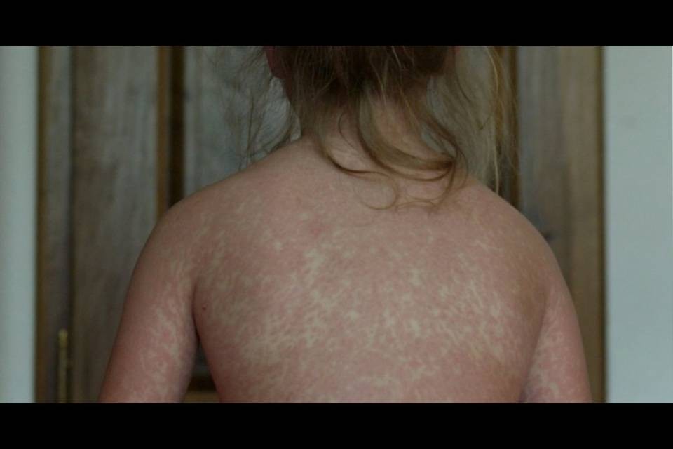 Giovane muore di morbillo