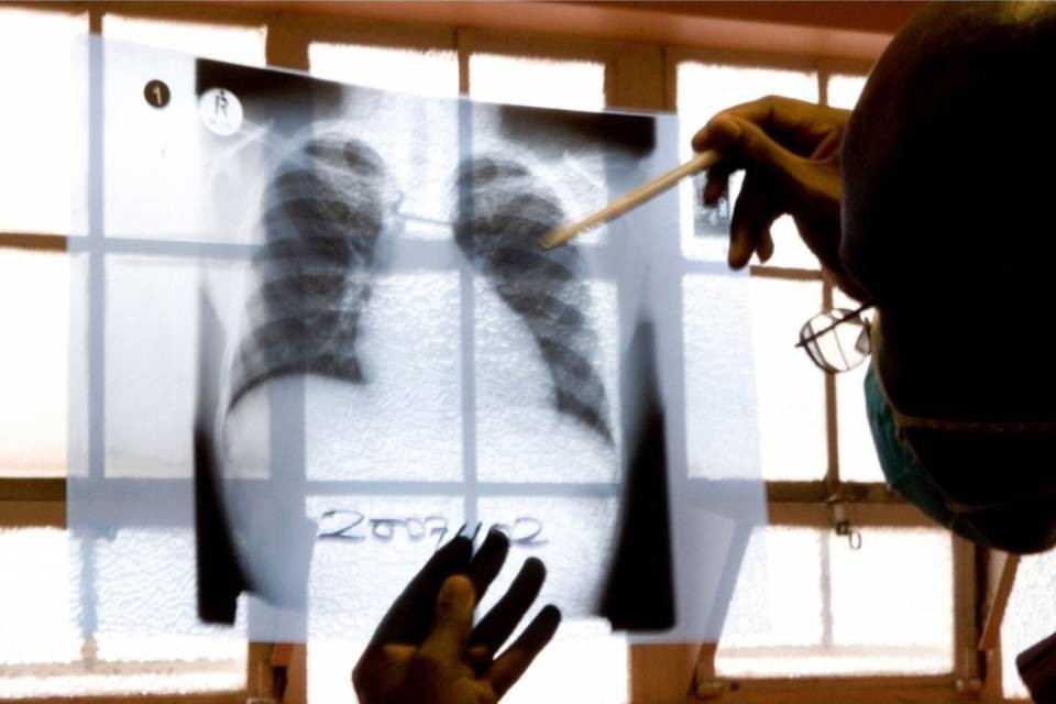 "Nessun caso di tubercolosi sui mezzi pubblici"