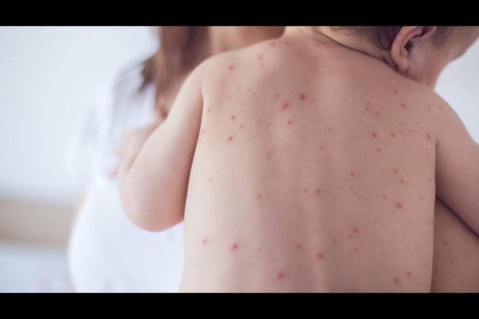 Due morti per morbillo in Svizzera