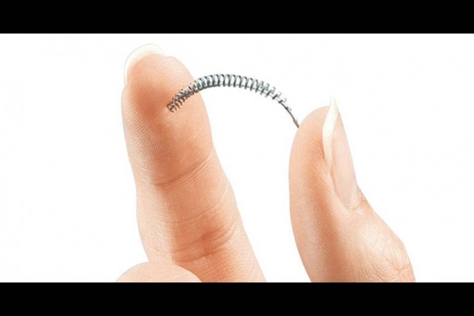 Attenzione al contraccettivo Essure