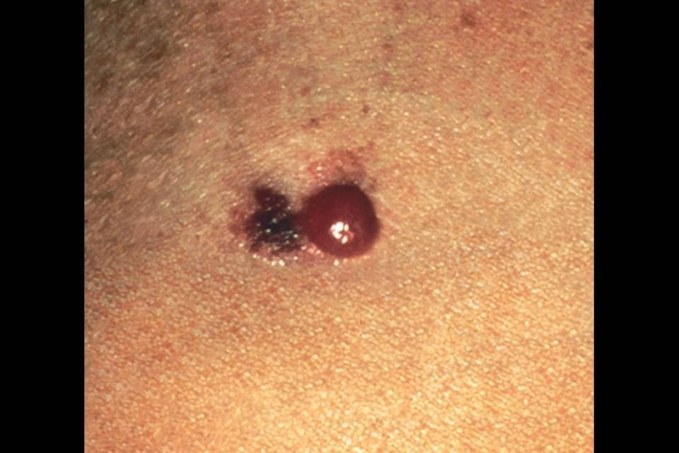 "Cancro della pelle e melanoma malattie professionali"