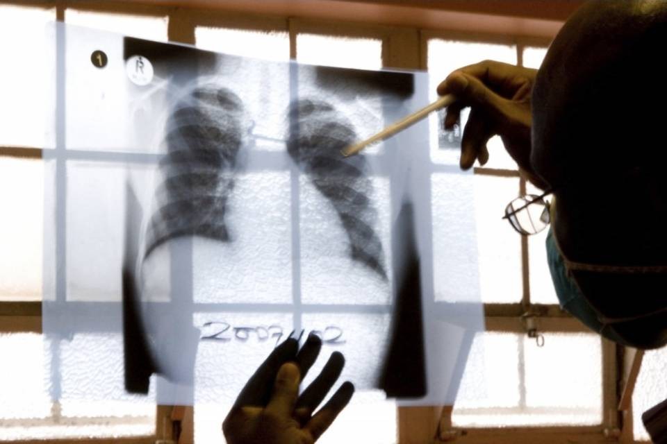 620 nuovi casi di tubercolosi in Svizzera