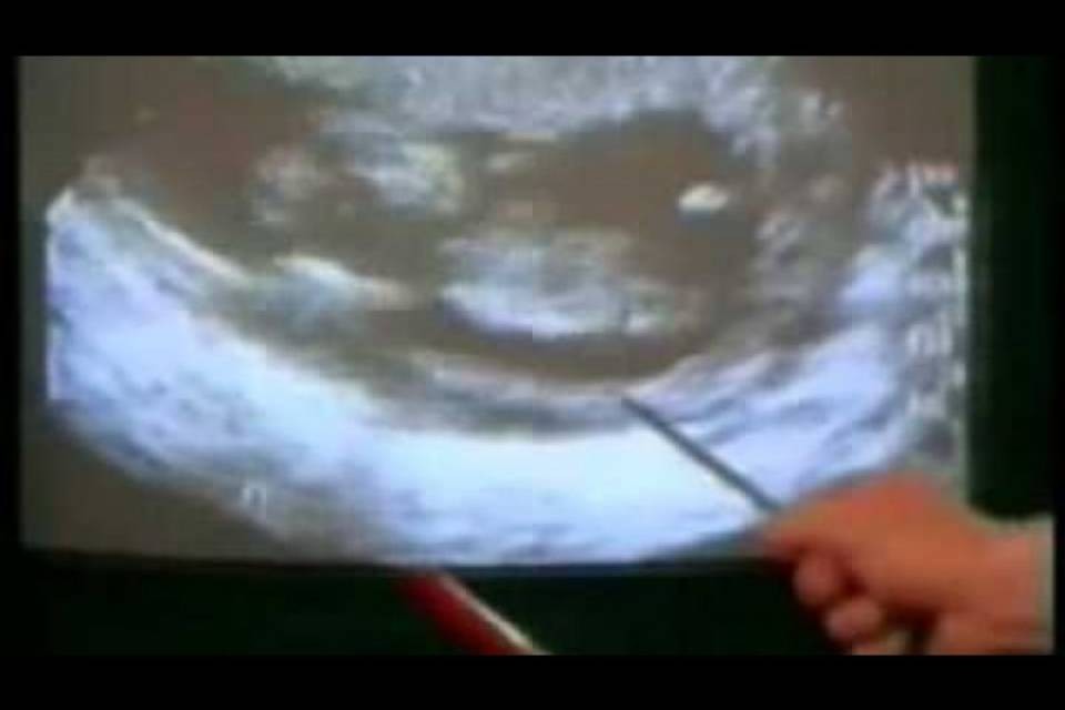 Anche in Lousiana l'aborto diventa illegale
