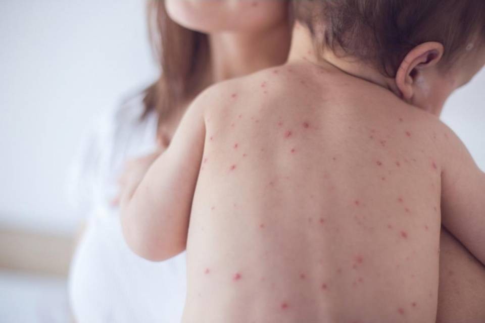 In aumento i casi di morbillo