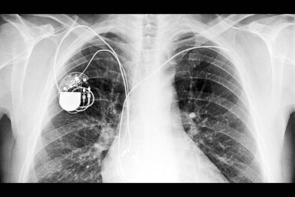 Allerta per dispositivi medici: rischio di attacchi informatici nei pacemaker