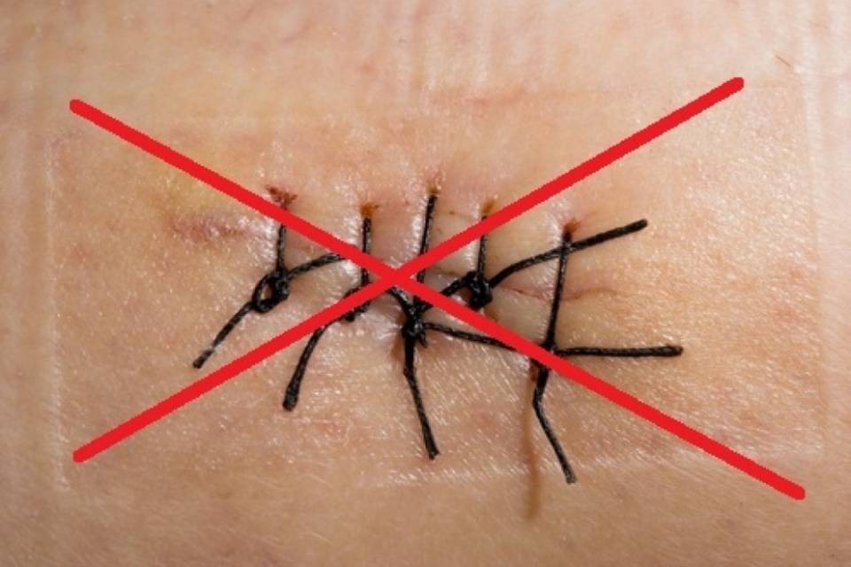 Ricercatori sviluppano colla per chiudere le ferite