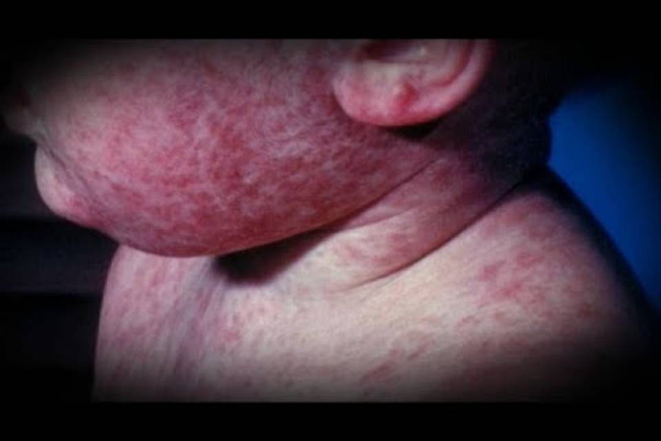 Allarme morbillo, sempre più morti: "Vaccinazioni insufficienti"