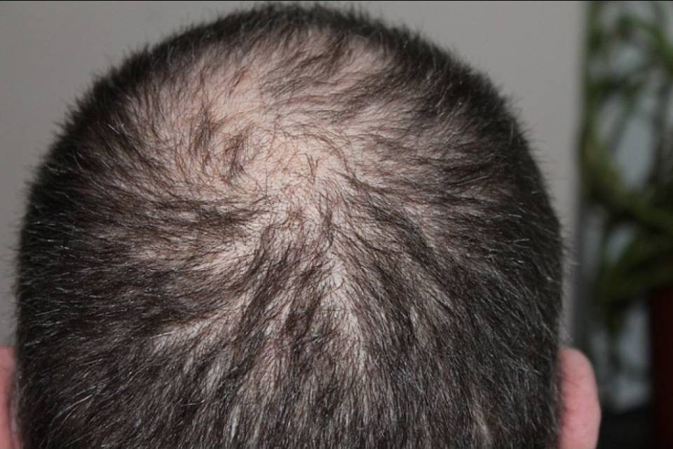 Caduta dei capelli, 11 cibi per prevenirla