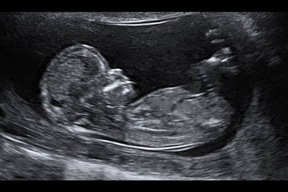 New York è la prima città a finanziare l'aborto